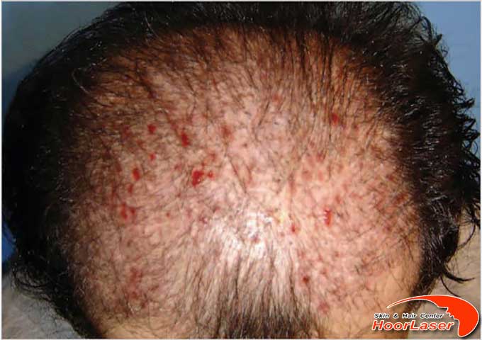فولیکولیت یا جوش بعد از کاشت مو