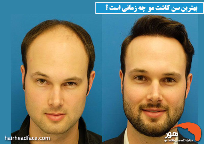 بهترین سن کاشت مو 