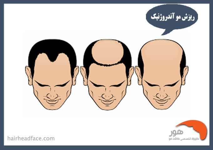 ریزش موی آندروژنیک 