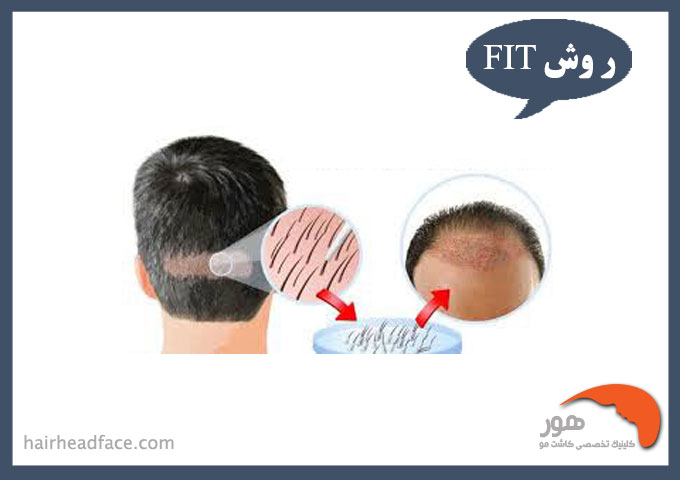 کاشت مو با روش fit