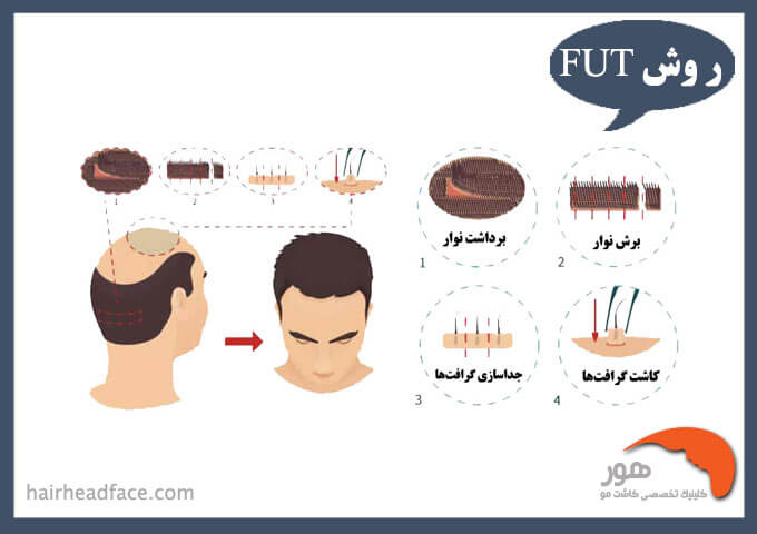 روش fut در کاشت مو 