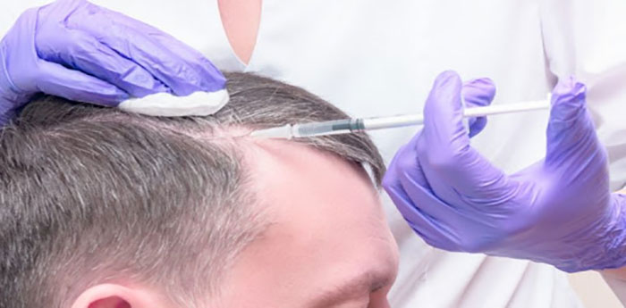 درمان ریزش مو ارثی در مردان
