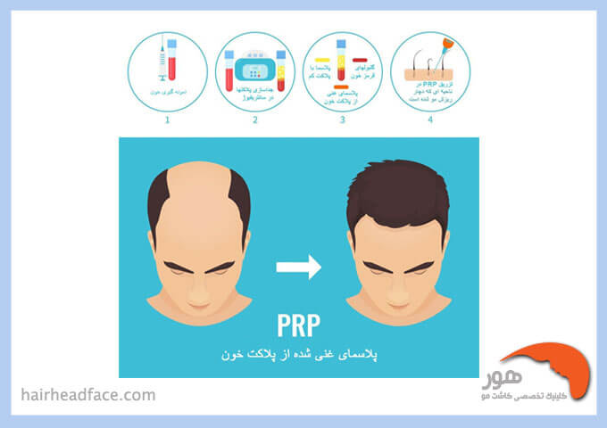 پی آر پی مو برای درمان ریزش مو ارثی