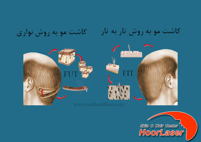 تفاوت کاشت مو fit و fut جیست
