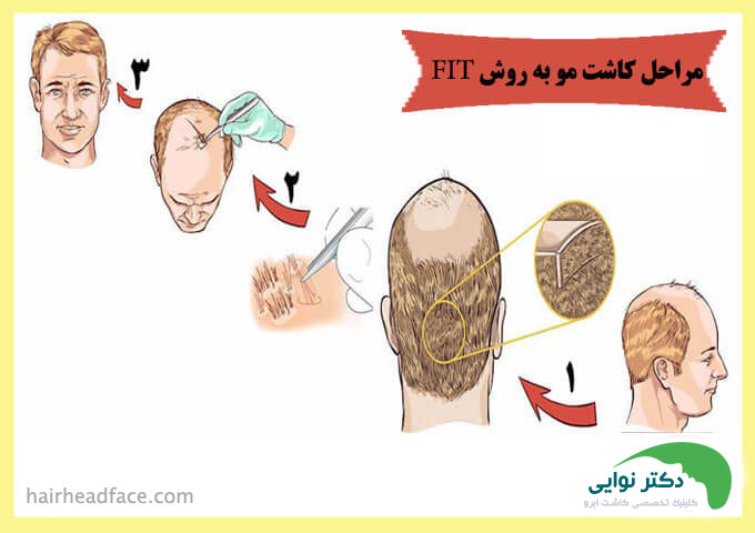 مراحل کاشت مو به روش fit