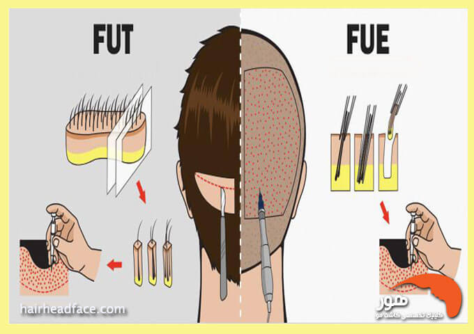 مراحل کاشت مو به روش fut