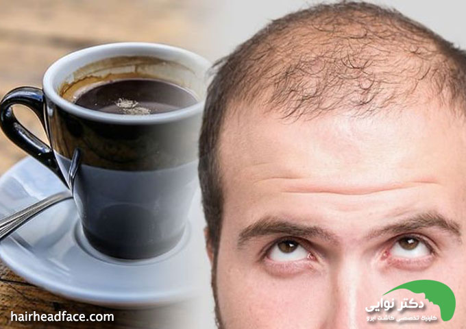 خوردن قهوه بعد از کاشت مو 