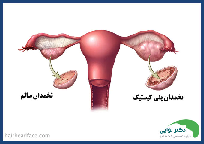 کیست تخمدان و ریزش مو نی نی سایت 