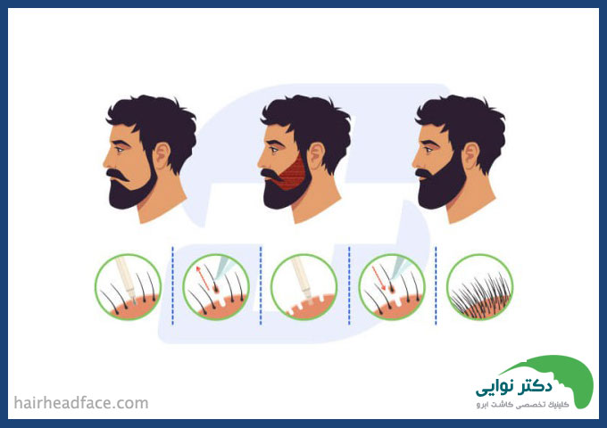 بهترین روش کاشت ریش 