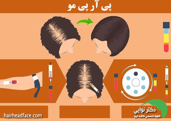 بهترین دکتر برای پی آر پی مو در اصفهان 