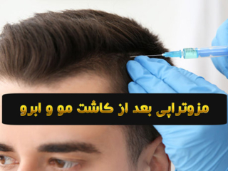 انجام مزوتراپی بعد از کاشت مو و کاشت ابرو