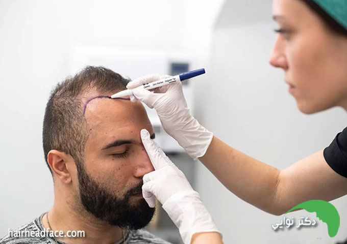 بهترین کاشت مو اصفهان