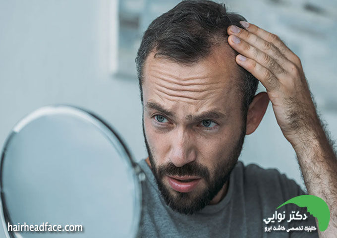 ریزش مو استرسی