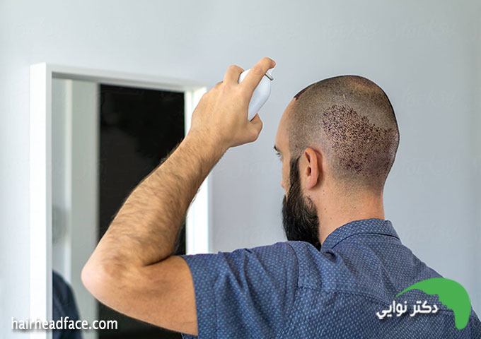آب پاشی سر در شب اول کاشت مو