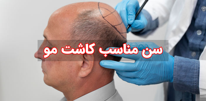 بهترین سن کاشت مو برای آقایان