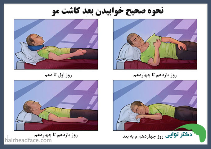 بعد از کاشت مو چند روز باید نشسته خوابید
