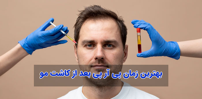 بهترین زمان پی آر پی بعد از کاشت مو