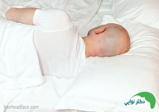 خوابیدن به پهلو باعث آسیب به کاشت مو می ‌شود؟