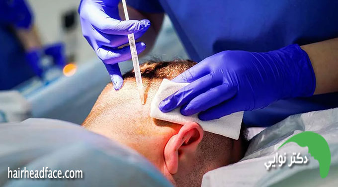کاشت مو از ناحیه تناسلی امکان پذیر است