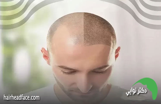 زور زدن بعد کاشت مو
