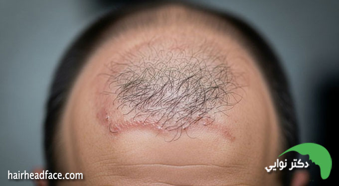 روند رشد مو بعد از کاشت 