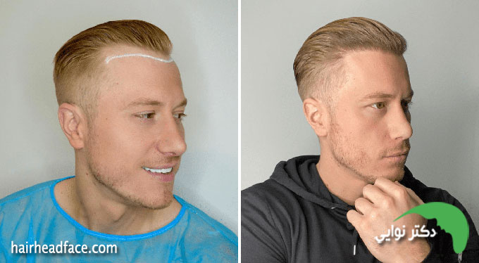 مراحل رشد مو بعد از کاشت 