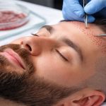 کاشت مو از ریش