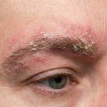 عفونت های قارچی پس از کاشت ابرو