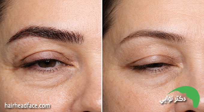 علت افتادگی پلک بعد از کاشت ابرو 