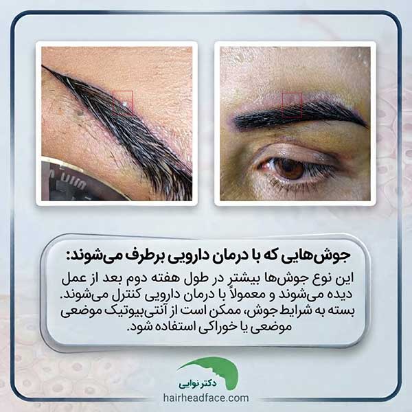 عکس جوش ابرو بعد از کاشت