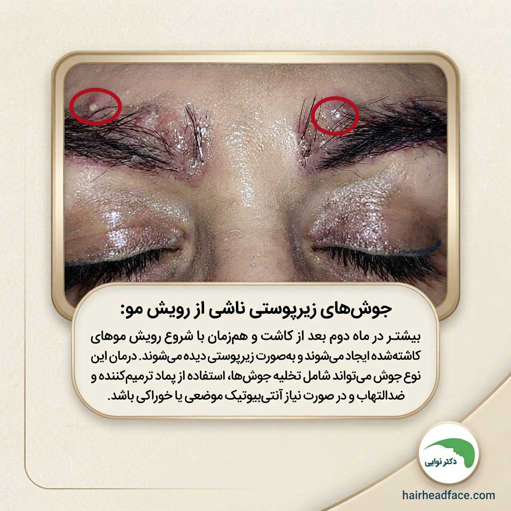 عکس جوش ابرو بعد از کاشت 
