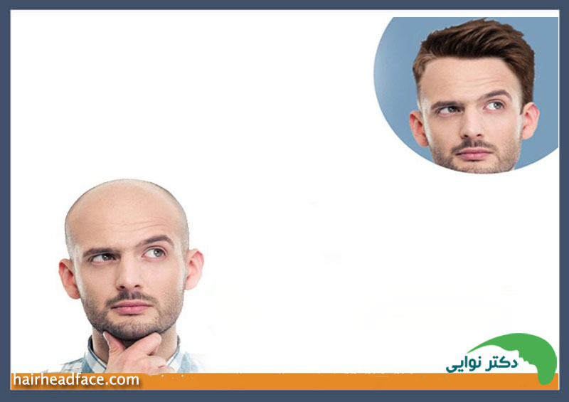نریختن مو بعد از کاشت 