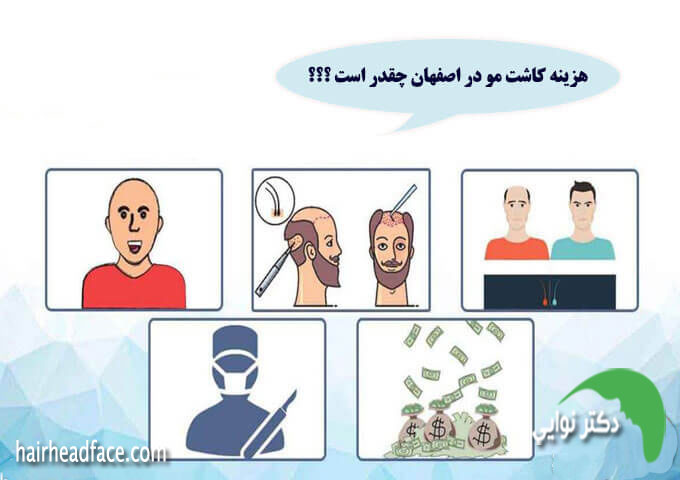هزینه کاشت مو در اصفهان