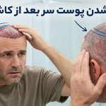 سفت شدن پوست سر بعد از کاشت مو