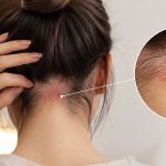 سوزش پشت سر بعد از کاشت ابرو