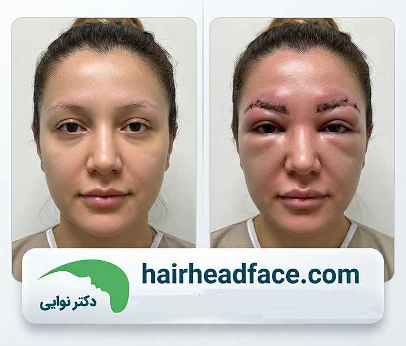 عکس قبل و بعد ورم بعد از کاشت ابرو 