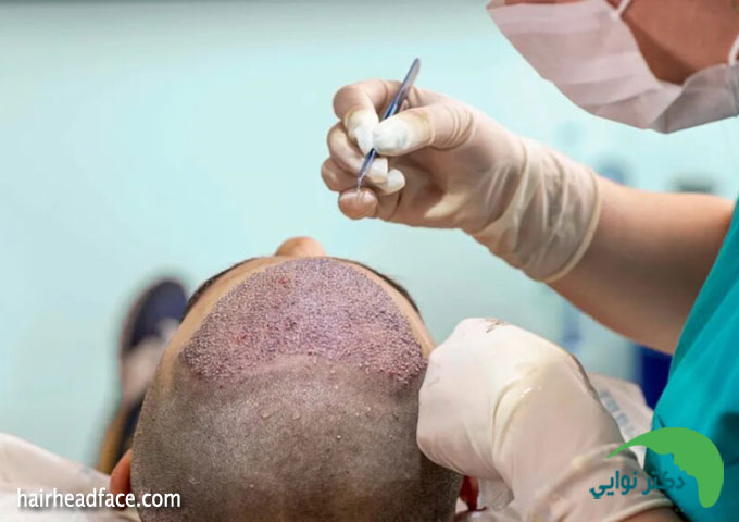 بهترین کلینیک کاشت مو در اصفهان