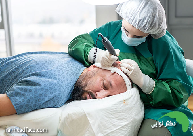 بهترین دکتر کاشت مو در اصفهان