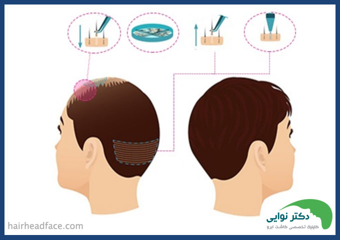 کاشت مو اصفهان