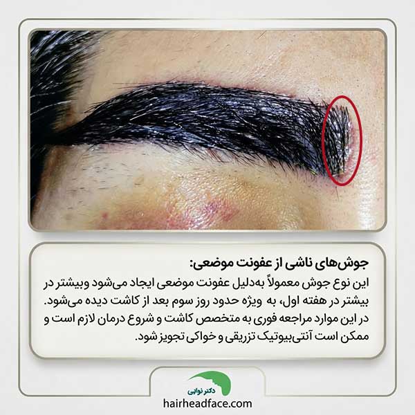 عکس جوش ابرو بعد از کاشت