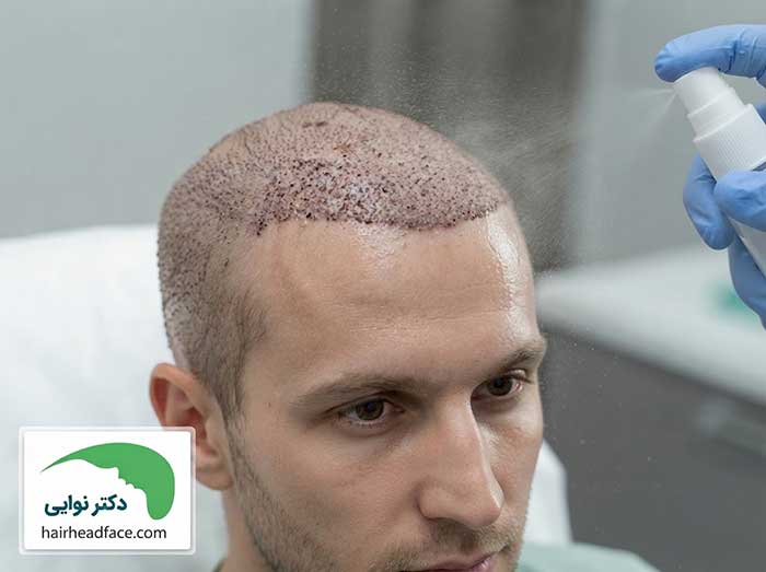 اسپری آب بعد از کاشت مو