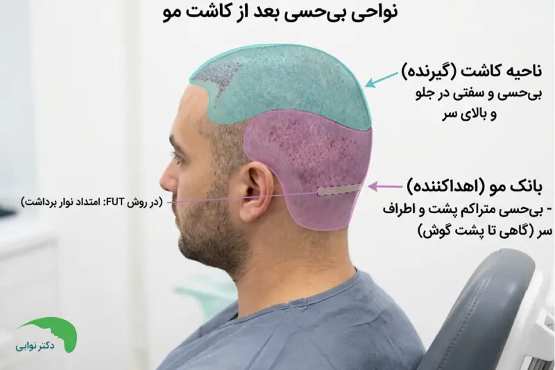 بیحسی بانک مو و ناحیه کاشت